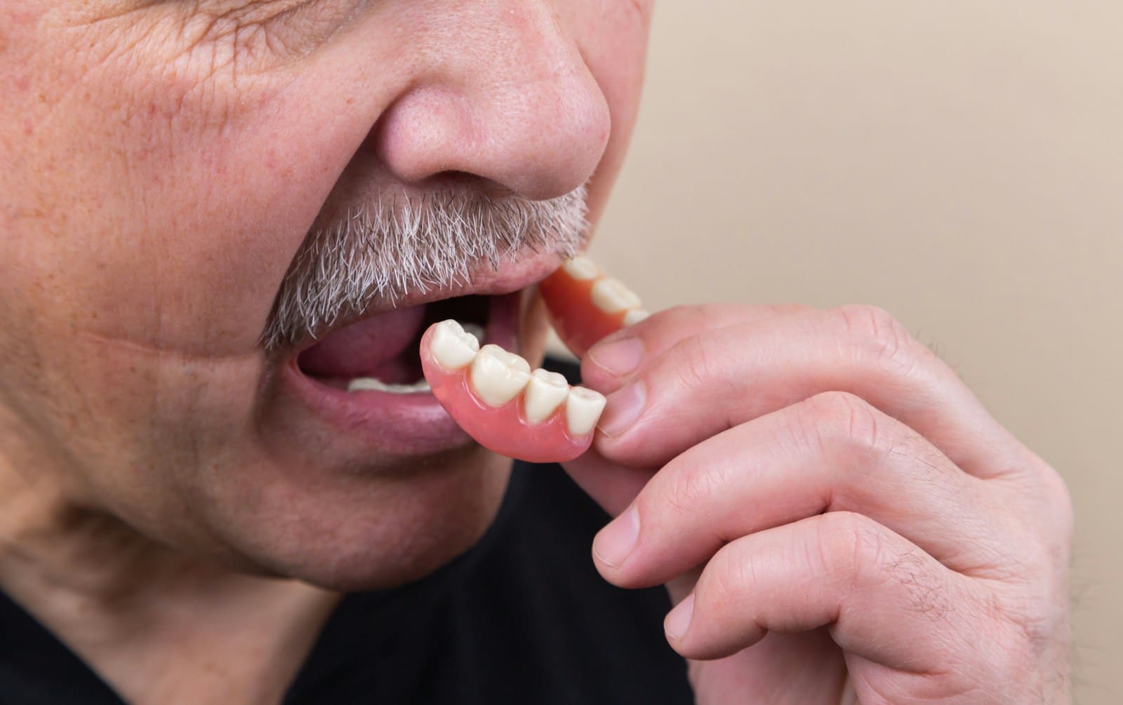Remboursement Dentier Fixe : Une Solution Moderne et Durable